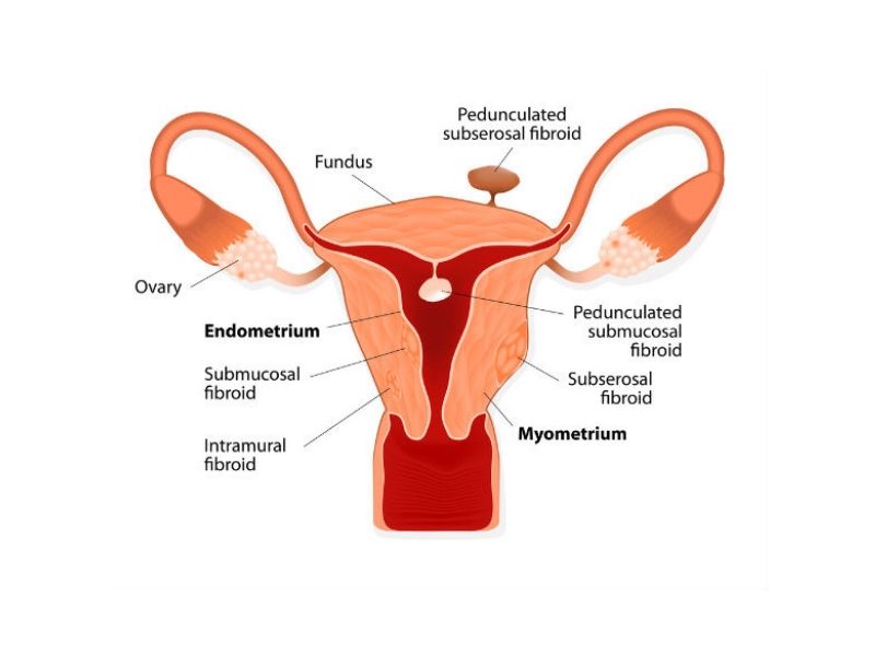 fibromul-uterin-sanatatea-femeii-programul-antitumoral-tiande